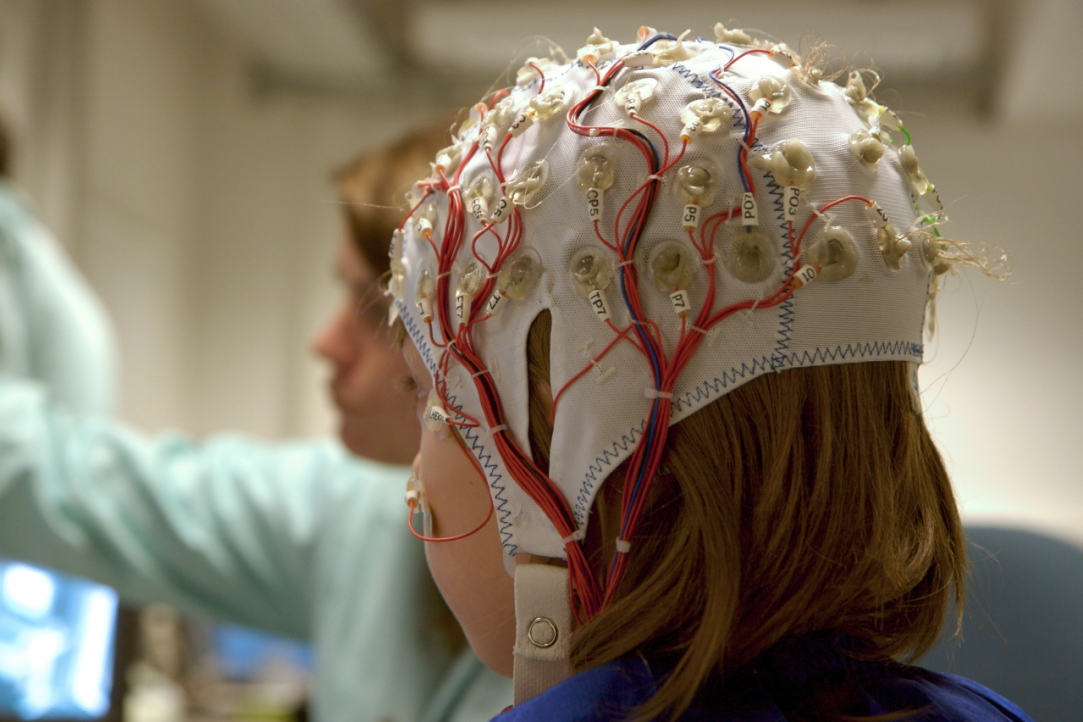Российские ученые создали биомиметический алгоритм поиска эпилептогенных зон мозга